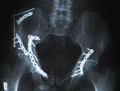 IV Collaborates on New Pelvic Fracture Surgery with Top Canadian Research  Organizations | Intellectual Ventures