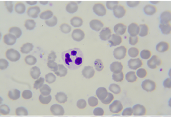 Global Good & GE Partner on Malaria Diagnostics